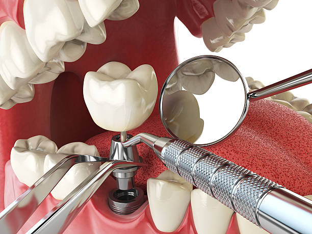 Best Emergency Tooth Extraction in Jamul, CA